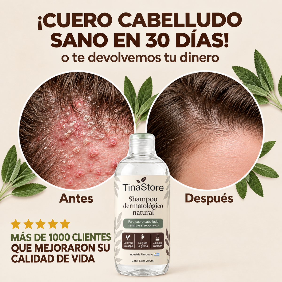 TinaStore | Shampoo para la caspa, psoriasis capilar y dermatitis seborreica