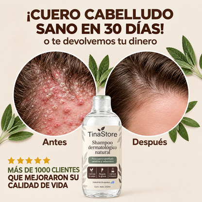 TinaStore | Shampoo para la caspa, psoriasis capilar y dermatitis seborreica
