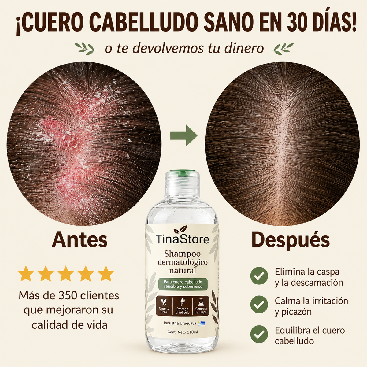 TinaStore | Shampoo para la caspa, psoriasis capilar y dermatitis seborreica