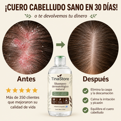 TinaStore | Shampoo para la caspa, psoriasis capilar y dermatitis seborreica
