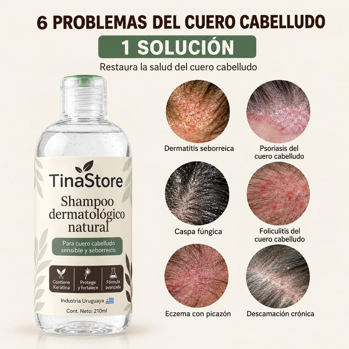 TinaStore | Shampoo para la caspa, psoriasis capilar y dermatitis seborreica