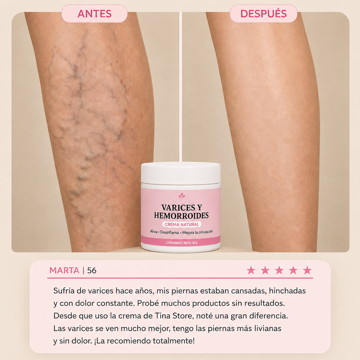 Crema Natural para Varices y Hemorroides | Alivio real, Piernas Livianas