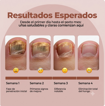 TINA: El Serum que elimina el 99.9% de los hongos en tus uñas.